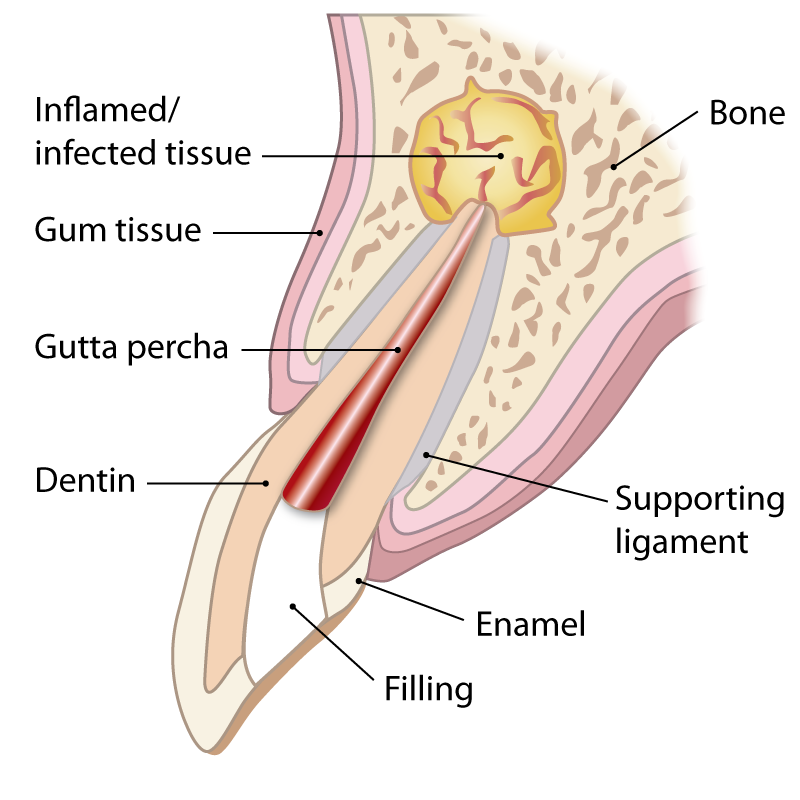 apicoectomy